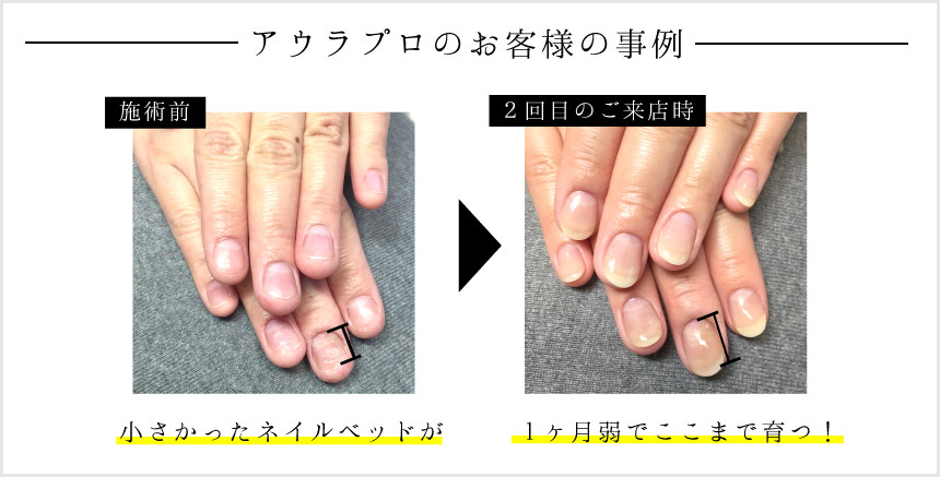 アウラプロのお客様の事例、小さかったネイルベッドが1ヶ月弱でここまで育つ！
