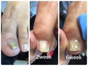 重度の巻き爪補正左足の様子　スタート時～6週間後