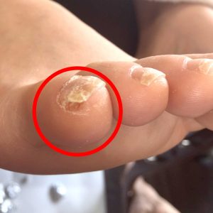 角質が溜まり爪が変形　施術前