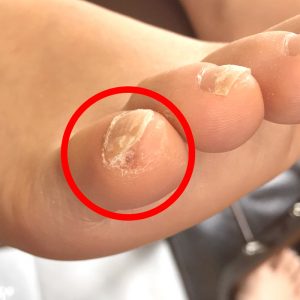 角質が溜まり爪が変形　角質除去後