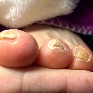 角質による爪の変形　施術前