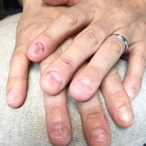 むしり癖による爪の形のお悩み（自爪状態：重度）自爪育成施術前