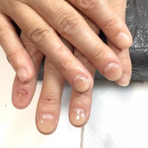 むしり癖による爪の形のお悩み（自爪状態：重度）自爪育成施術後