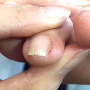 爪の溝に溜まった角質　施術後