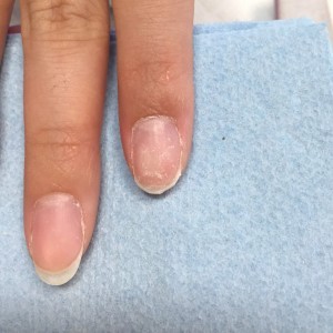 欠けた爪の補修　施術前