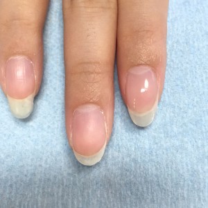 欠けた爪の補修　施術後