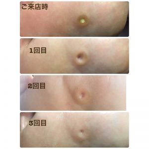 足裏の魚の目　施術による変化