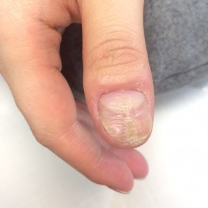 自爪育成（自爪状態：中度）1回目の施術前