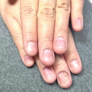 自爪育成（自爪状態：重度）スタート時