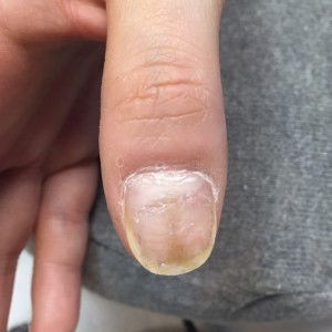 自爪育成（自爪状態：中度）2回目のご来店時