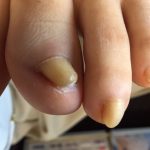 なぜ巻き爪になるの？
