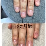自爪育成で爪が成長